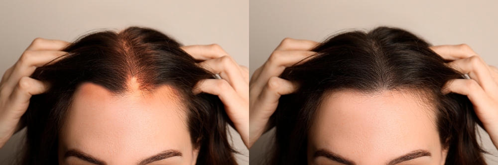 Woman,Before,And,After,Hair,Treatment,With,High,Frequency,Darsonval