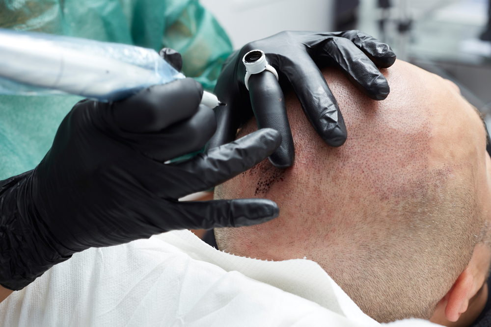 Cosmetologist,Making,Permanent,Makeup,On,Male,Skin,Head, ,Tricopigmentation